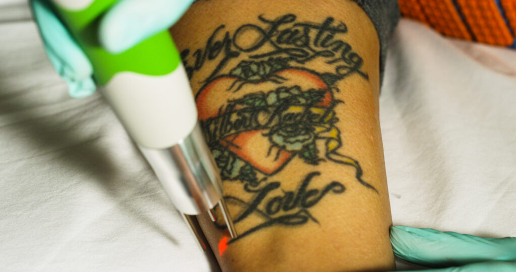 Ink Busters - Your Trusted Tattoo Removal Experts in Las Vegas