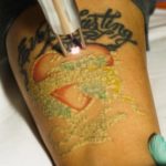 Laser Tattoo Removal on hand